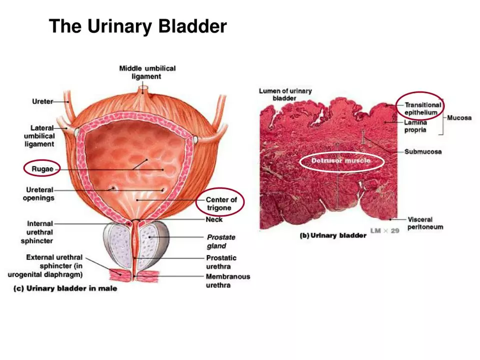 The connection between bladder stones and muscle spasms of the urinary tract
